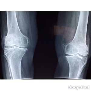Knee Replacement Surgery In Thane